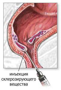 Инъекция склерозирующего вещества